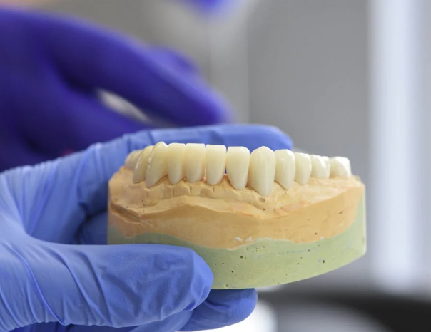 Implantes dentales en Valencia
