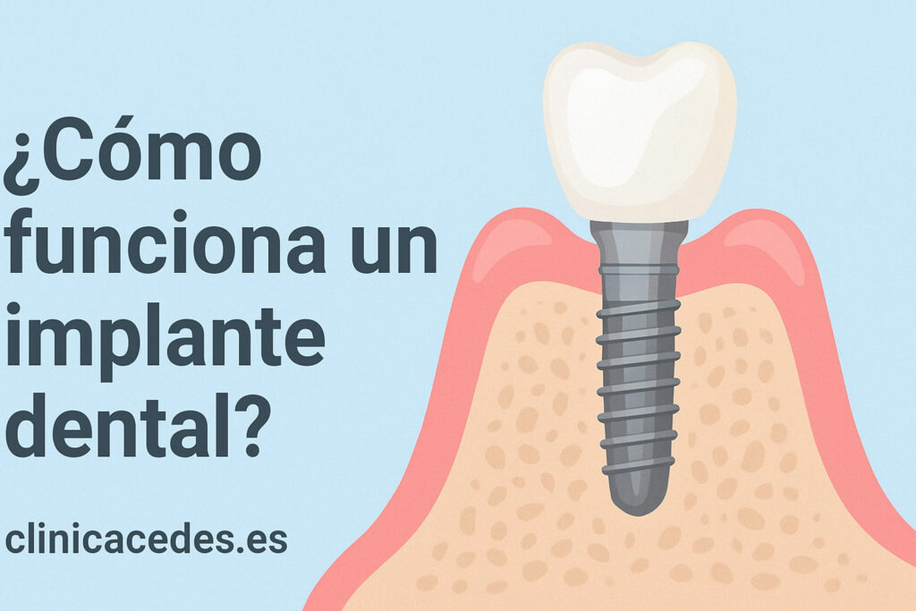 como funciona un implante dental