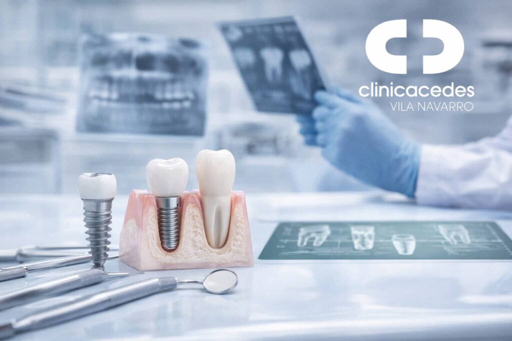 informacion relevante de implante dental