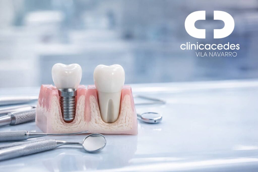 omo poner un implante dental con tornillo