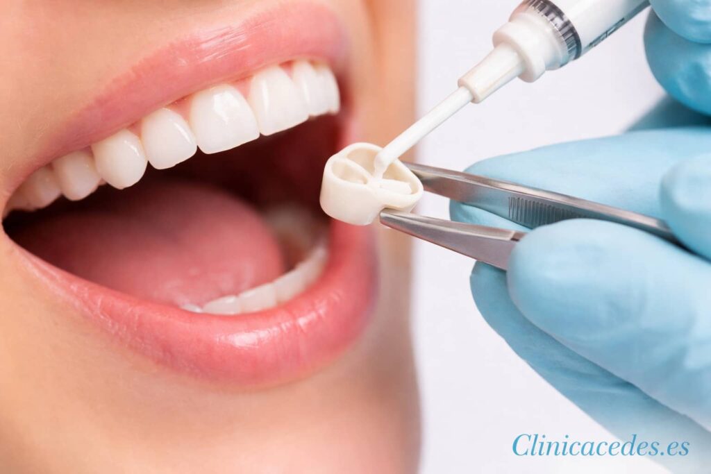 Dentista colocando y cementando una corona dental en un paciente en Clínica Cedes Valencia